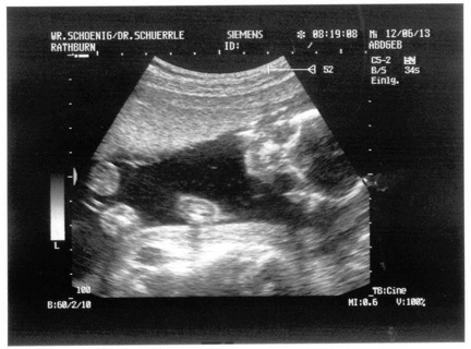 Ultrasound 12June2013a